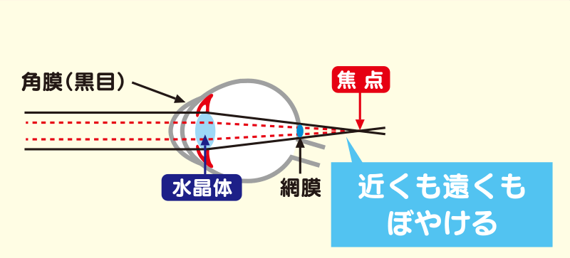 遠視とは